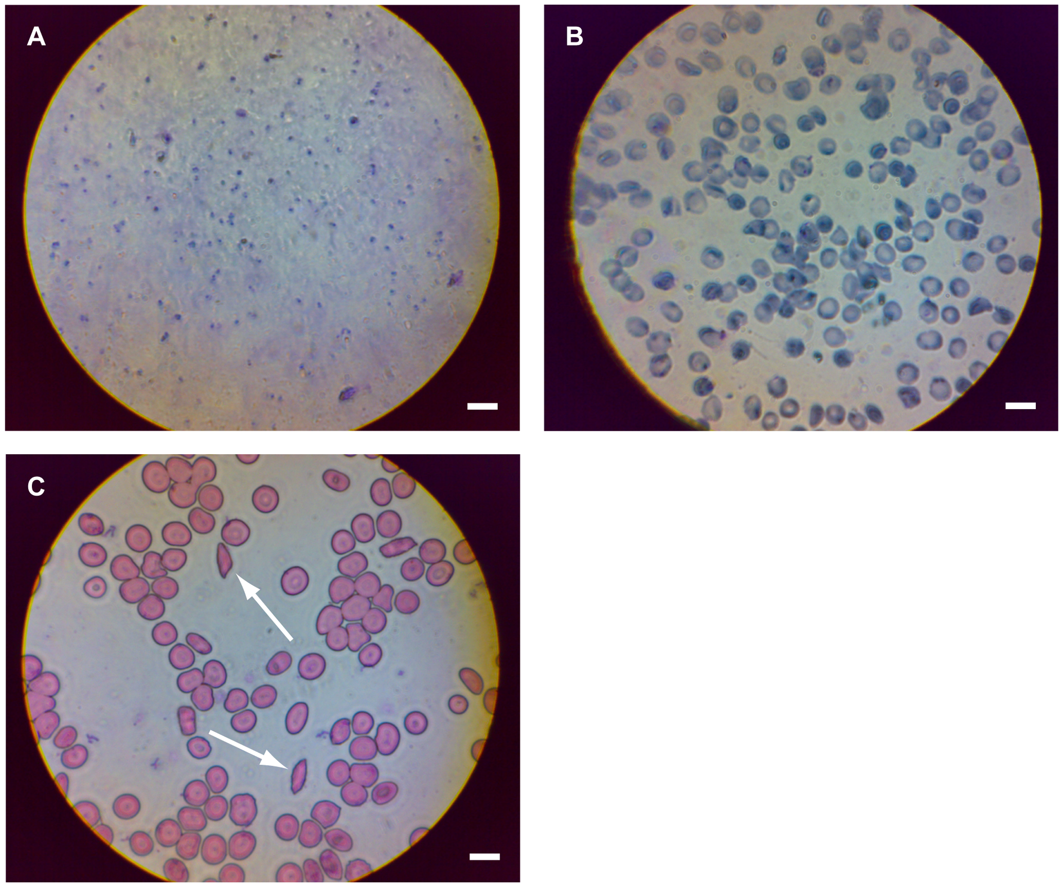 PLOS Figure 2: mobile phone microscopy images of diseased blood smears